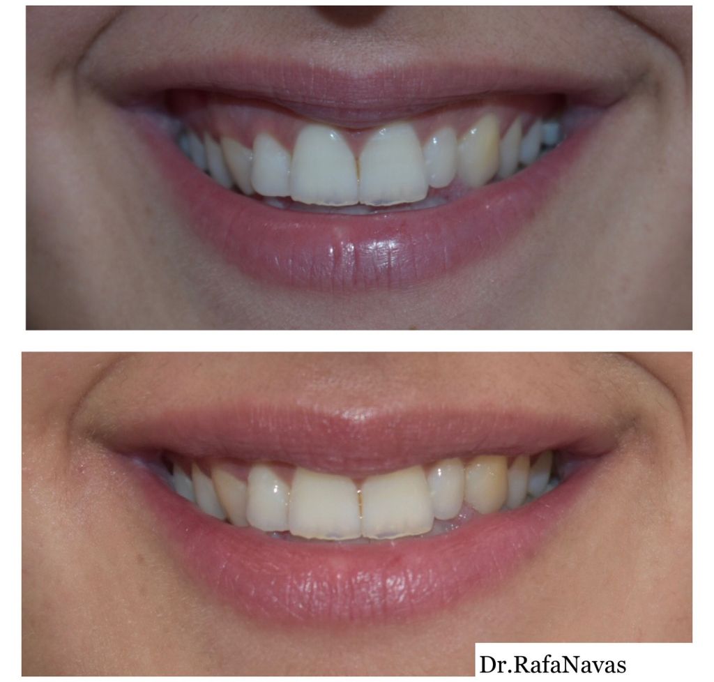 antes y despues tratamiento sonrisa gingival