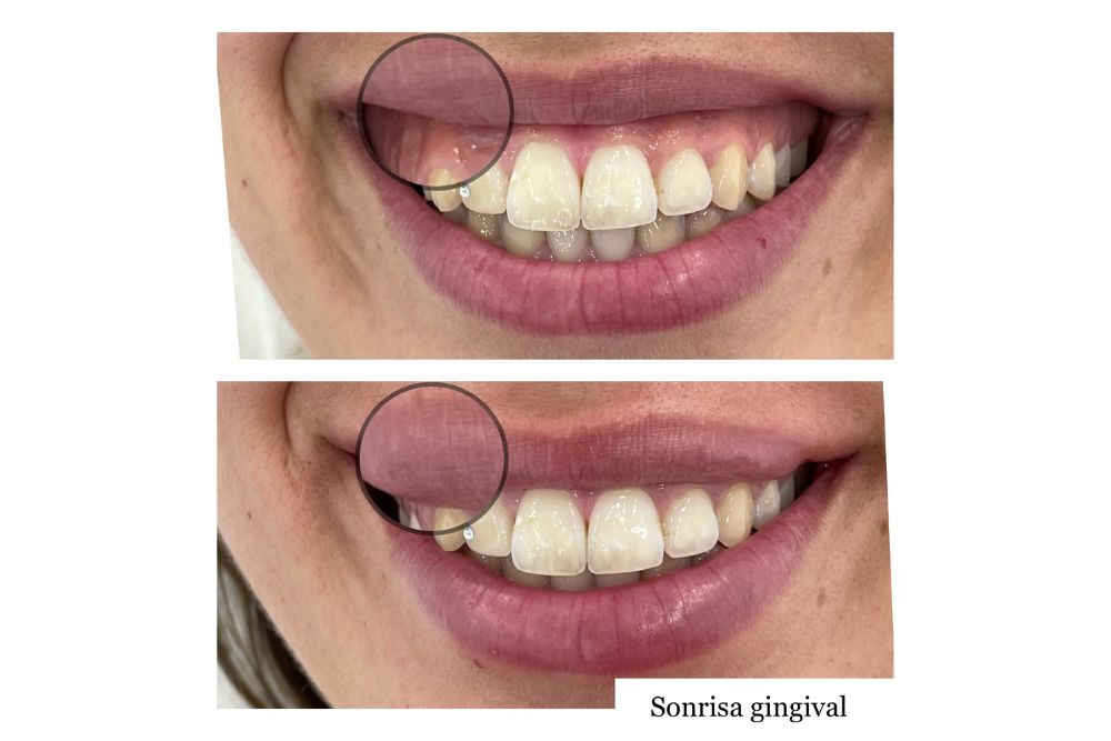 antes y despues sonrisa gingival