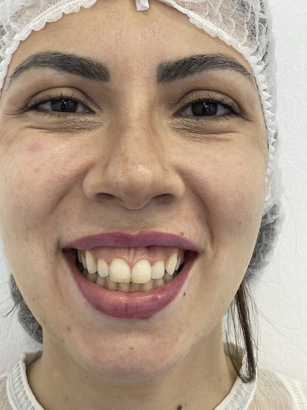 antes sonrisa gingival